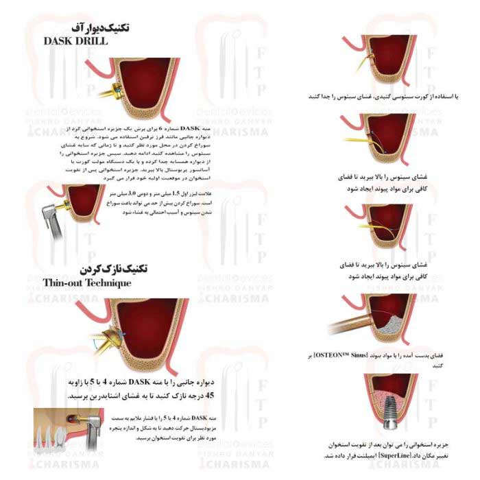 کیت سینوس لیفت کامل (کاریزما) - 2