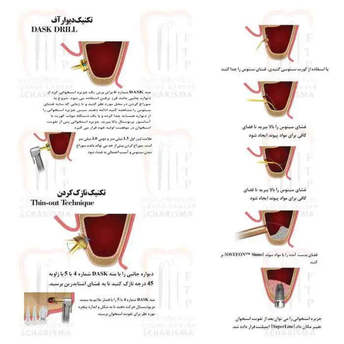 کیت سینوس لیفت کامل- کاریزما - 2