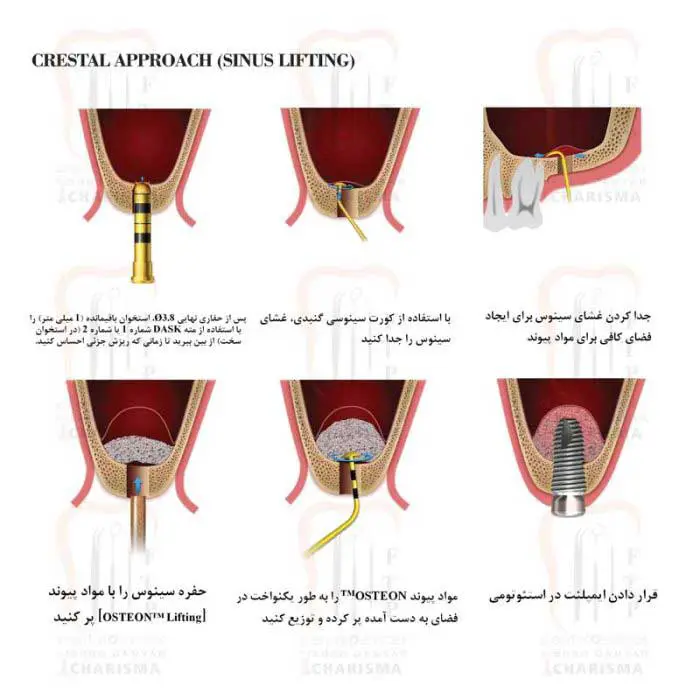 کیت سینوس لیفت کامل- کاریزما - 3