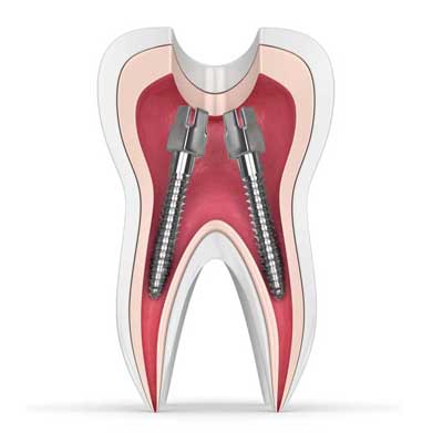 سایر مواد ترمیمی